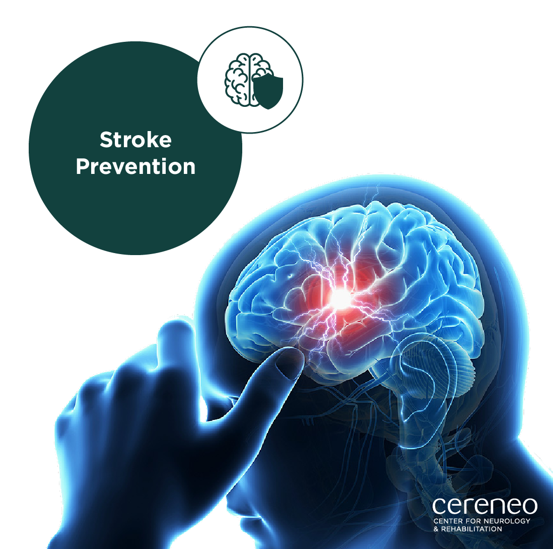 Stroke Prevention: Evidence-Based Approaches for Reducing Stroke Risk